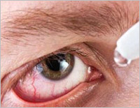 How to prevent conjunctivitis this monsoon